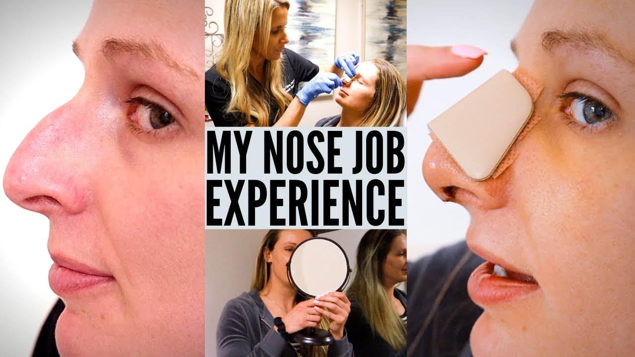 Nose job experience and consultation process images.