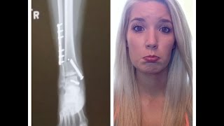 Story time: My Broken Ankle