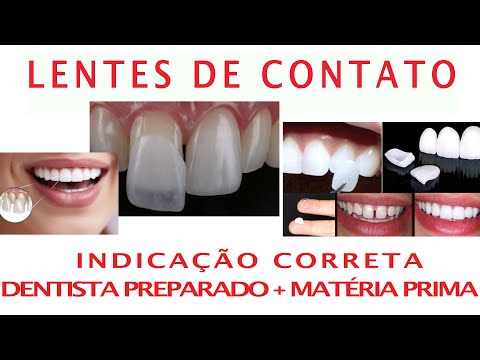 Lentes de Contato Dental   #dentessaudaveis #dentesbrancos #lentesdecontatodentais