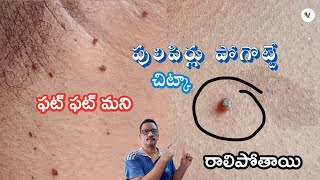 పులిపిర్లు సమస్యతో చాలా కాలం నుండి బాధ పడుతున్నారా అయితే ఇదే పరిష్కారం | pulipirlu in telugu.