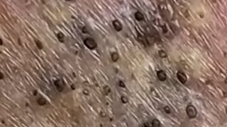 Blackheads & Whiteheads Satisfying Removal Acne and Pimple @0791