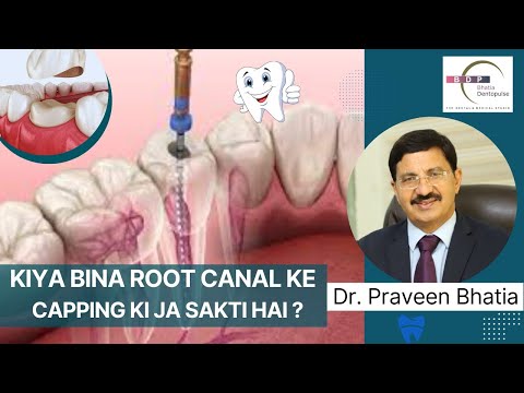 Can you get Teeth Capping without Root Canal? Kya Bina root canal ke capping ki ja sakti hai?