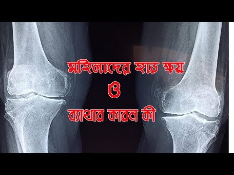 মহিলাদের হাড় ক্ষয় | MOHILADER HAR KHOY | Health tips | Moubd 2019 HD