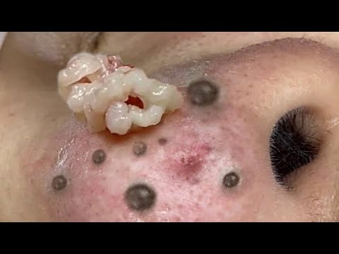 Blackhead Removal With Sac Dep Spa @100074290