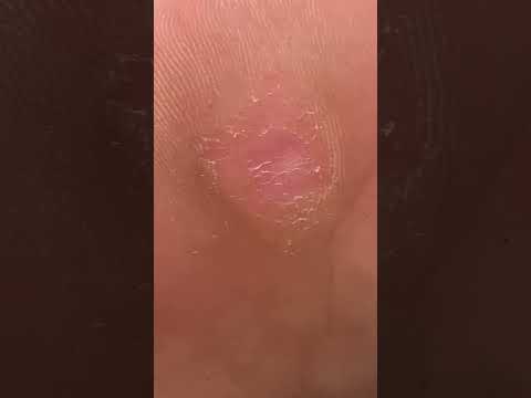 Watch Aussie podiatrist masterfully tackle forefoot corn & callus! #PodiatryMagic #FootCareDownUnder