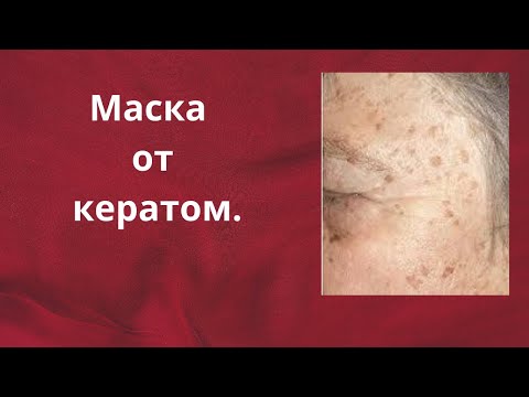 Кератомы и пигментация. Домашняя маска для лица от пятен на коже.