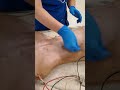 Surgical Scrubbing Techniques