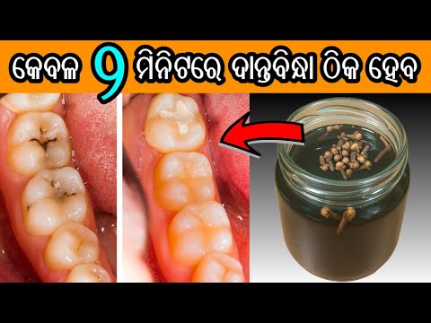 ଶୋଇବା ପୂର୍ବରୁ ୧ କପ ଗାର୍ଗଲ କରନ୍ତୁ, ଦାନ୍ତବିନ୍ଧା ଗାୟବ ହୋଇଯିବ | Tooth Decay Treatment