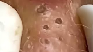 Blackheads & Whiteheads Satisfying Removal Acne and Pimple @0786