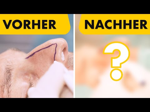 Geschlossene Nasen-OP bei 41-jährigem Mann | Vorher Nachher Vergleich MIT OP VIDEO!  Dr. Jungwirth