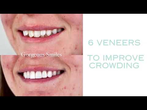 Veneers B&A video