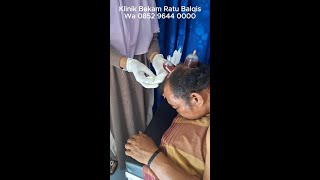 Stroke sebelah kanan Bekam drh beku di otak
