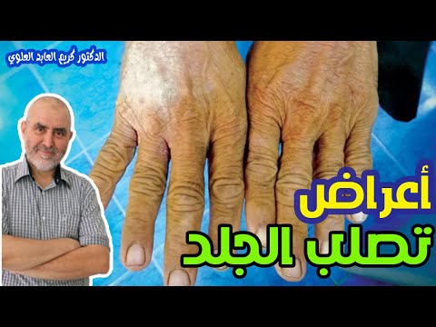 تصلب الجلد ماهو و لماذا يحدث ؟؟   -  الدكتور كريم العابد العلوي  -