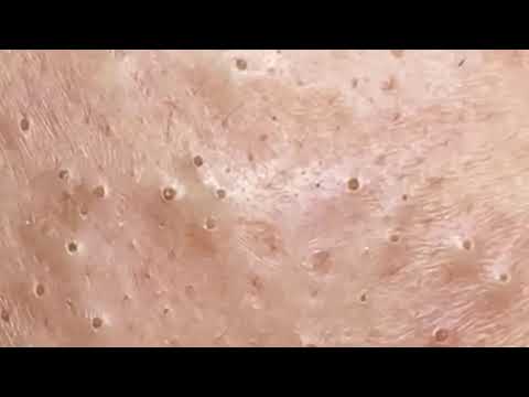 Blackheads & Whiteheads Satisfying Removal @0375