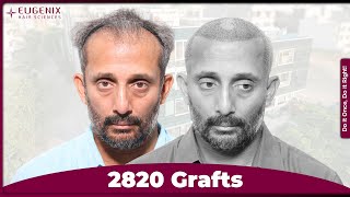 Ashwin Krishnan’s Hair Transplant Journey at Eugenix | 2,820 Grafts | NW Grade 4
