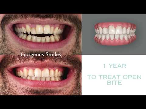 Invisalign B&A Video