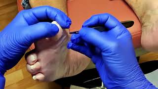 Deep Callus Removal & A Lesson in Positivity #DrNailNipper #CallusRemoval #FootCare #Podiatry