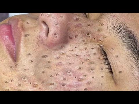 Big Cystic Acne Blackheads Extraction Blackheads & Milia, Whiteheads Removal Pimple Popping # 8405