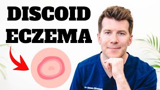 Doctor explains Discoid Eczema | Causes, Symptoms, Photos and Treatment
