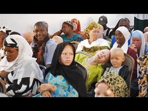 Sensibilisation à l'albinisme : AMPA et la JCI Bko Etoile au chevet des enfants albinos