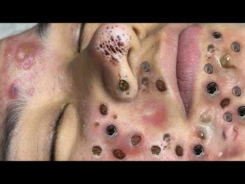 Blackhead Removal With Sac Dep Spa @100074551
