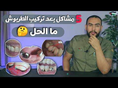 5 مشاكل خطيره بعد تركيب الطربوش احذرها😱 | اسباب وعلاج الالم بعد تركيب الطربوش او الكوبرى 🙄