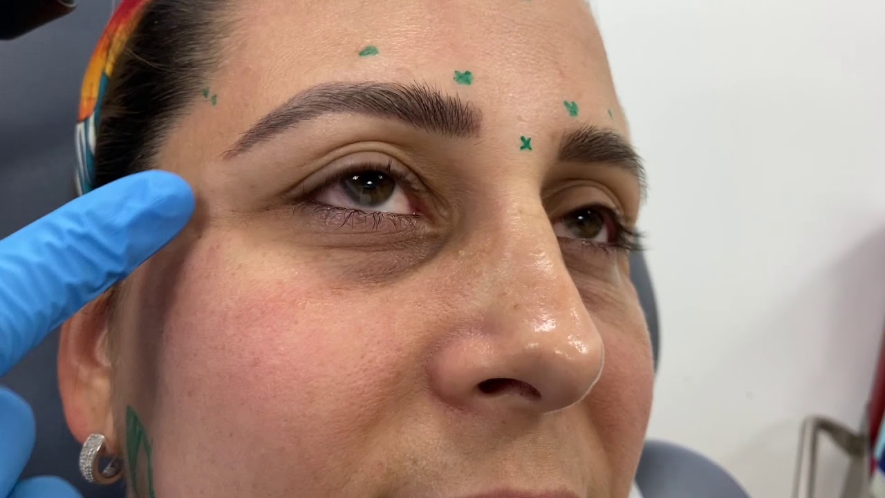 Woman with markings for cosmetic procedure preparation.