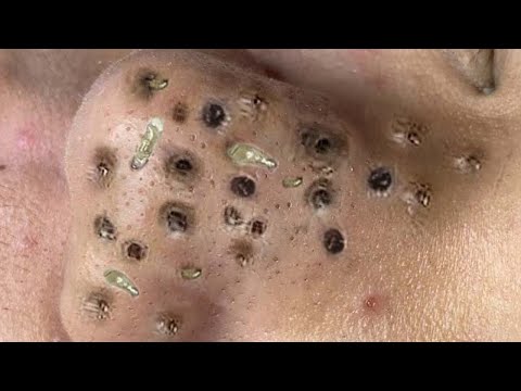 Blackhead Removal With Sac Dep Spa @100074289