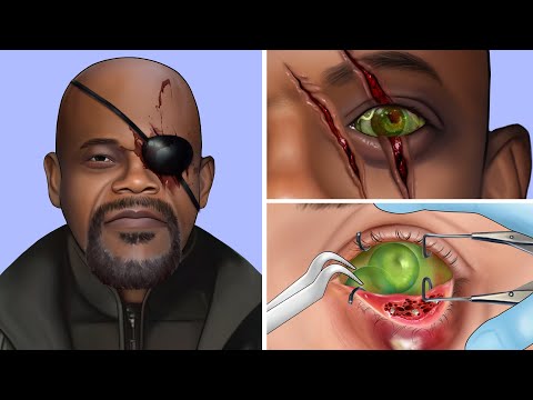 ASMR Remove Maggot, Dogticks Infected Eyes Compilation - Deep Cleaning Animation