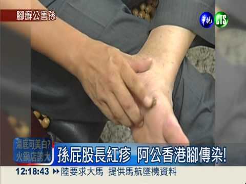 3 爺摳香港腳傳染 孫屁股長