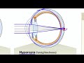 Understanding Vision and Eye Conditions