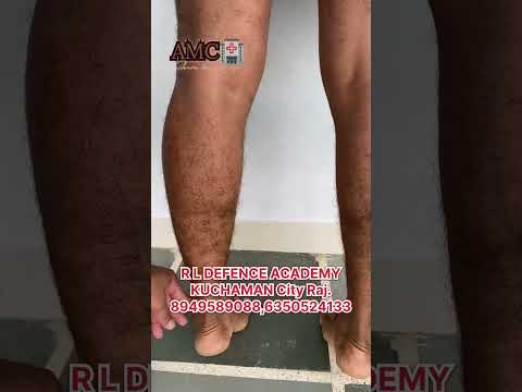 Varicose vein’s and Deformity Problem लाडलें आये प्रीं-Medical के लिये || Army Medical| SSCGD #viral