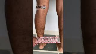 Varicose vein’s and Deformity Problem लाडलें आये प्रीं-Medical के लिये || Army Medical| SSCGD #viral