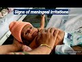 Signs of Meningeal Irritation