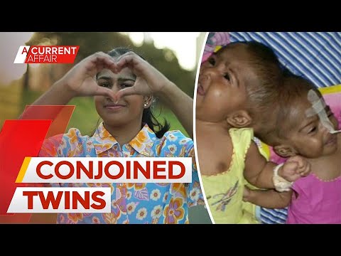 Conjoined twins' life after being separated | A Current Affair