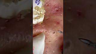 Skincare | Blackheads Removal #459 #tweezers skincare #blackheads blackheads