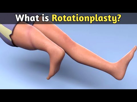 What is Rotationplasty explained in Hindi/Urdu