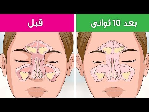 علاج انسداد الانف والتهاب الجيوب الانفية فى 30 ثانية فقط