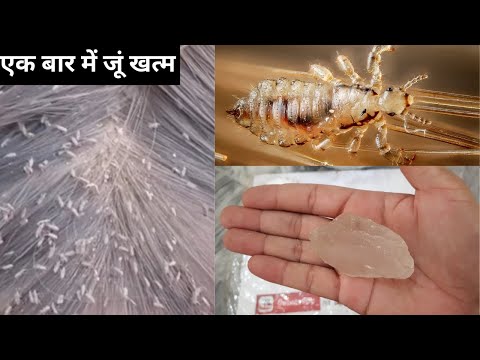 सिर की जूं, लीख, रूसी 1 बार में हमेशा के लिए जड़ से खत्म lice treatment at home