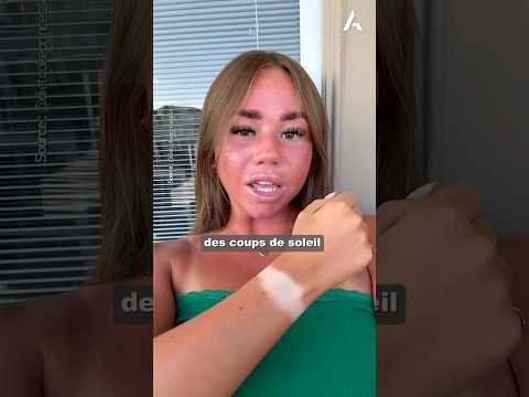Coup de soleil : la nouvelle mode 🥵