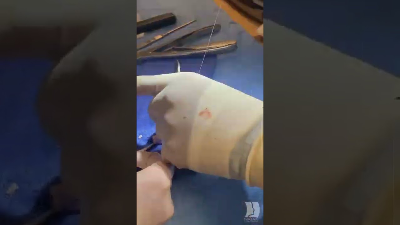 Surgical procedure in progress with gloved hands.