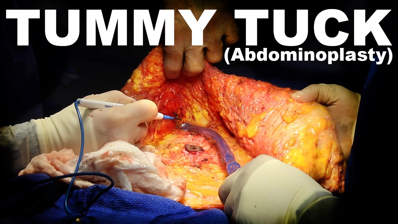 Surgical procedure of tummy tuck (abdominoplasty) illustrating.