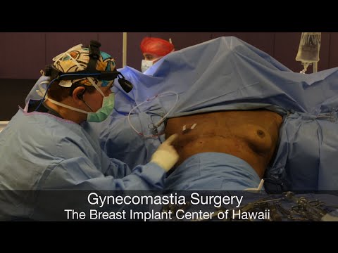 Gynecomastia Surgery (Graphic) - Removal of Male Breast Tissue (Man Boobs) - Gynecomastia Hawaii