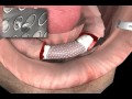 Stereolithography and Surgical Procedures