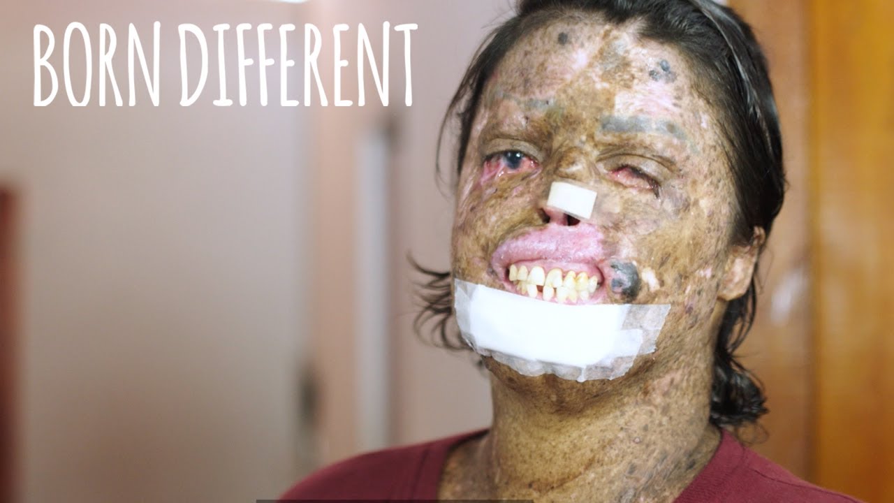 The woman who is allergic to sunlight - born different
