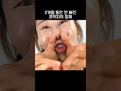 코 재수술썰
