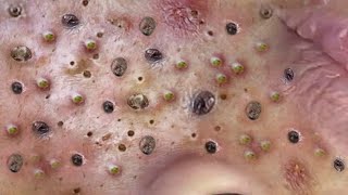 Loan Nguyen Acne Treatment 132c