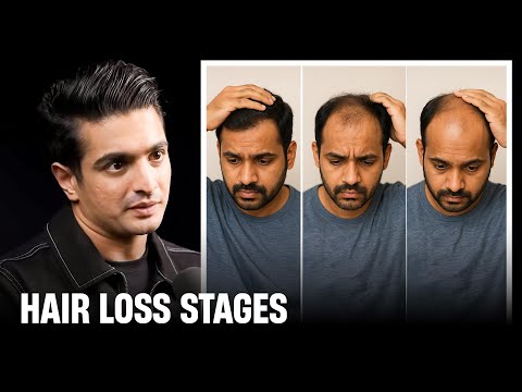 Why Young Men Are Losing Hair Faster