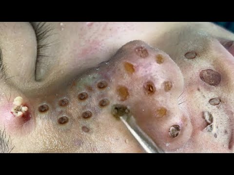 Blackhead Removal With Sac Dep Spa @100074547