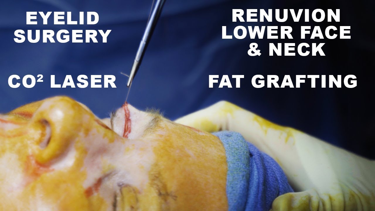 Eyelid surgery with CO2 laser and fat grafting